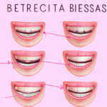 Brackets: 5 Beneficios Para Una Sonrisa Perfecta